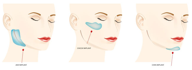 facial-implants-jaw-implants-check-implants